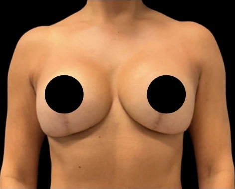 After: Breast Aug/Lift · by Angelo Cuzalina, MD, DDS