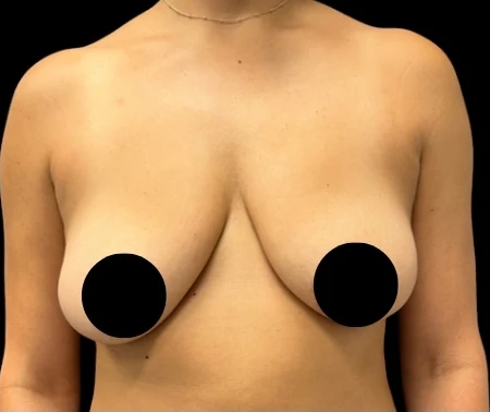 Before: Breast Aug/Lift · by Angelo Cuzalina, MD, DDS
