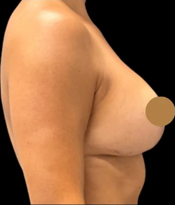 After: Breast Aug/Lift · by Angelo Cuzalina, MD, DDS