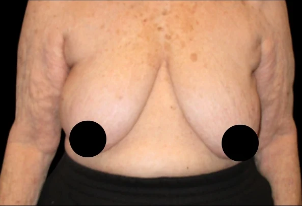 Before: Breast Augmentation & Lift · by Angelo Cuzalina, MD, DDS