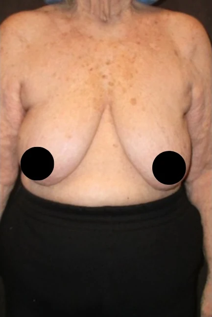 Before: Breast Aug/Lift · by Angelo Cuzalina, MD, DDS