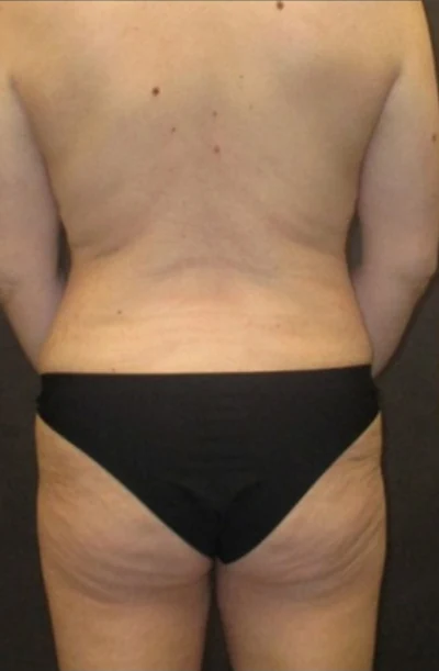 Before: Tummy Tuck, Lipo to Abdomen, Breast Aug/Lift & BBL — back · by Angelo Cuzalina, MD, DDS