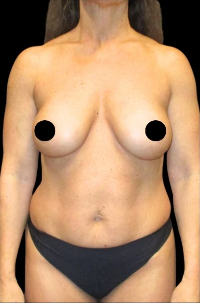 Before: Breast Aug/Lift, Tummy Tuck, Lipo360 — front · by Angelo Cuzalina, MD, DDS