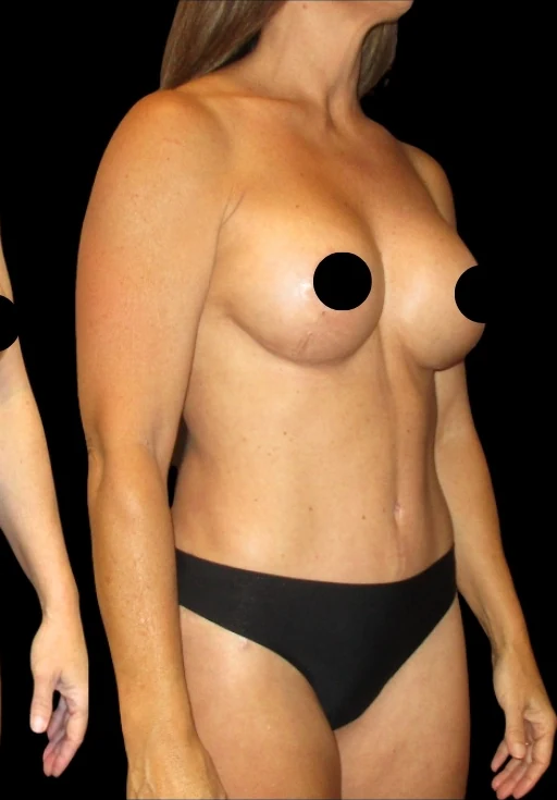 After: Breast Aug/Lift, Tummy Tuck, Lipo360 — oblique · by Angelo Cuzalina, MD, DDS