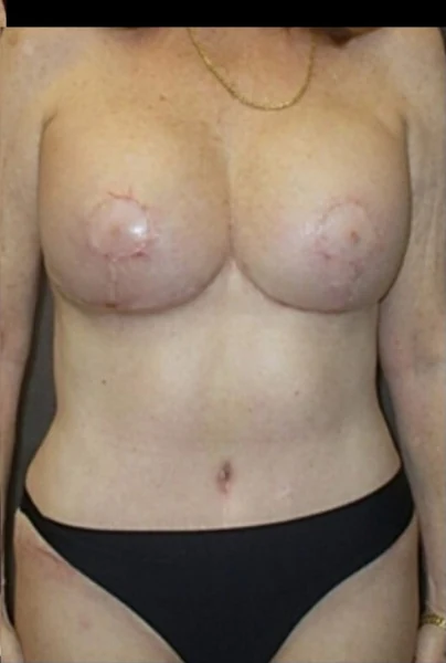 After: Breast Augmentation/Lift & Tummy Tuck — front-torso · by Angelo Cuzalina, MD, DDS