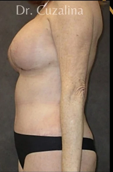 After: Breast Augmentation/Lift & Tummy Tuck — profile · by Angelo Cuzalina, MD, DDS