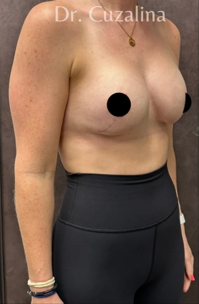 After: Breast Augmentation & Mini Lift — oblique · by Angelo Cuzalina, MD, DDS