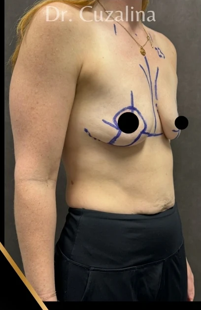 Before: Breast Augmentation & Mini Lift — oblique · by Angelo Cuzalina, MD, DDS