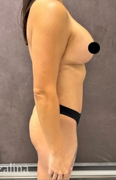 After: Full Mommy Makeover (Breast Aug/Lift | Lipo 360 | Lipo to Hips & Thighs | Tummy Tuck | ... — profile · by Angelo Cuzalina, MD, DDS