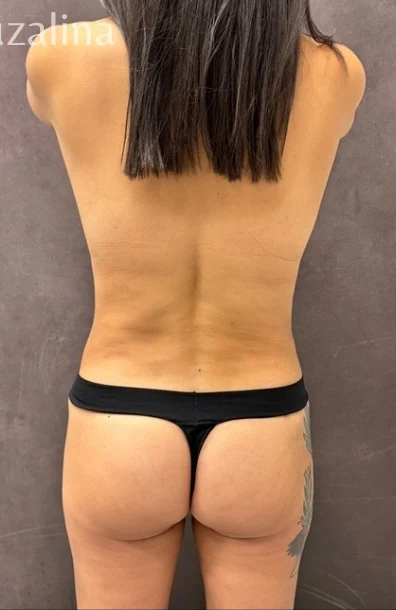 After: Full Mommy Makeover (Breast Aug/Lift | Lipo 360 | Lipo to Hips & Thighs | Tummy Tuck | ... — back · by Angelo Cuzalina, MD, DDS