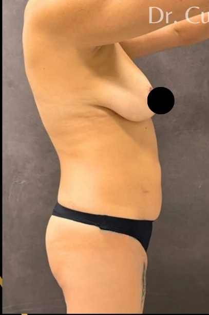 Before: Full Mommy Makeover (Breast Aug/Lift | Lipo 360 | Lipo to Hips & Thighs | Tummy Tuck | ... — oblique · by Angelo Cuzalina, MD, DDS