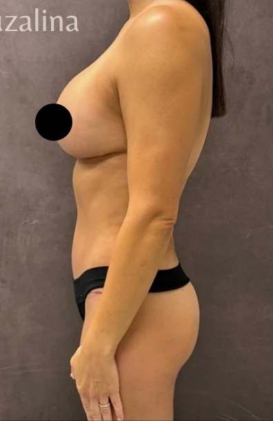 After: Full Mommy Makeover (Breast Aug/Lift | Lipo 360 | Lipo to Hips & Thighs | Tummy Tuck | ... — profile · by Angelo Cuzalina, MD, DDS
