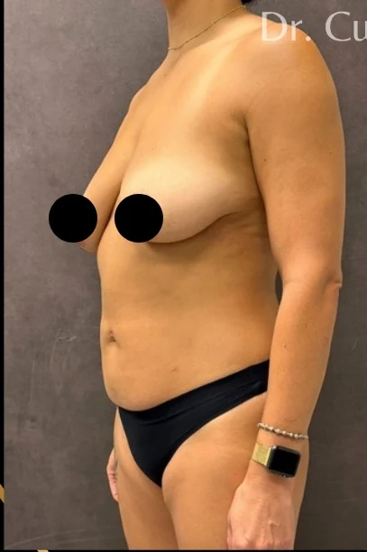 Before: Full Mommy Makeover (Breast Aug/Lift | Lipo 360 | Lipo to Hips & Thighs | Tummy Tuck | ... — three-quarter · by Angelo Cuzalina, MD, DDS