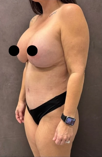 After: Mommy Makeover — oblique · by Angelo Cuzalina, MD, DDS
