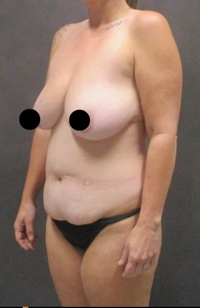 Before: Mommy Makeover — oblique · by Angelo Cuzalina, MD, DDS