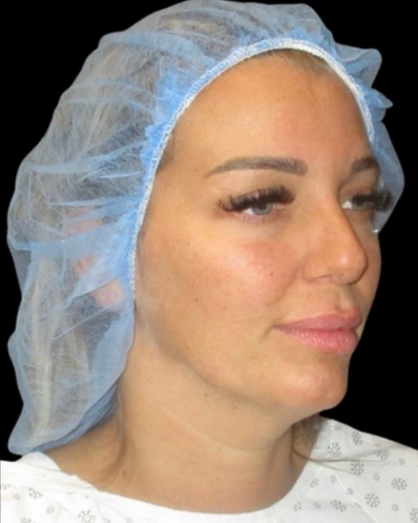 Before: Neck Lipo — three-quarter · by Carisa Champion, DO