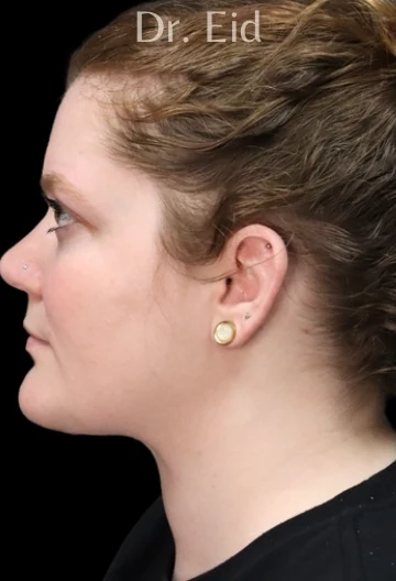 After: Submentoplasty — profile · by Rola Eid, DO, FACOS, FACS