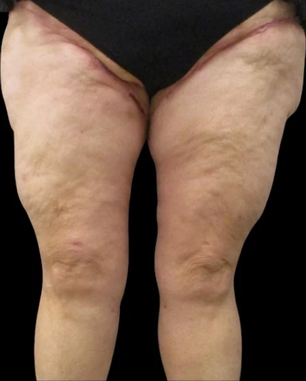After: Thigh Lift & Lipo · by Angelo Cuzalina, MD, DDS