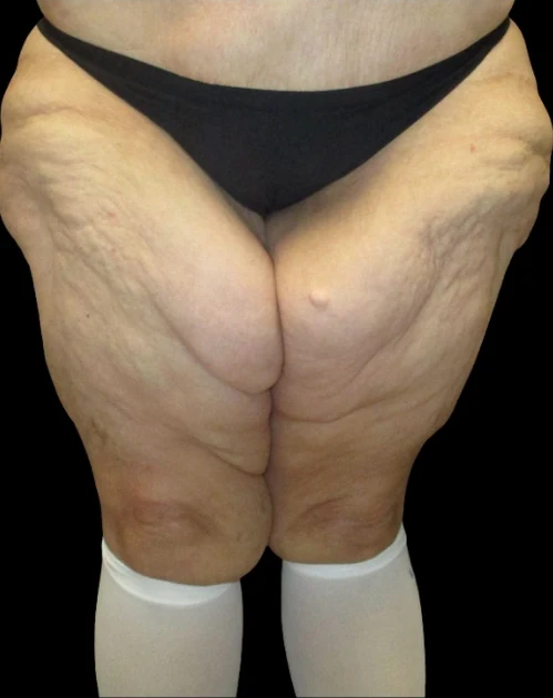 Before: Thigh Lift & Lipo · by Angelo Cuzalina, MD, DDS