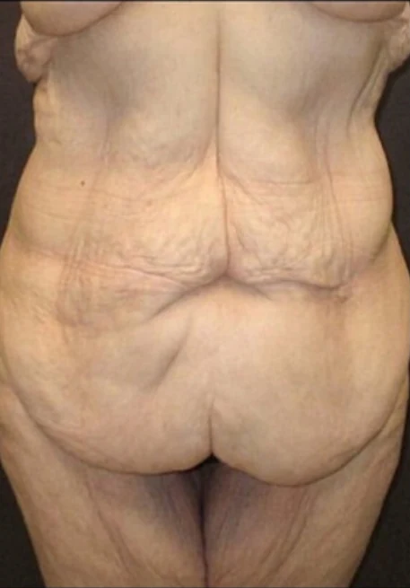 Before: Tummy Tuck / Excessive Skin Removal — back · by Angelo Cuzalina, MD, DDS