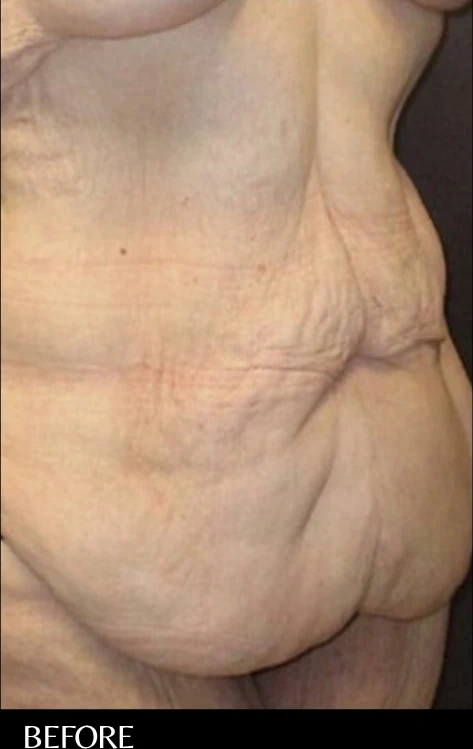 Before: Tummy Tuck / Excessive Skin Removal — front · by Angelo Cuzalina, MD, DDS