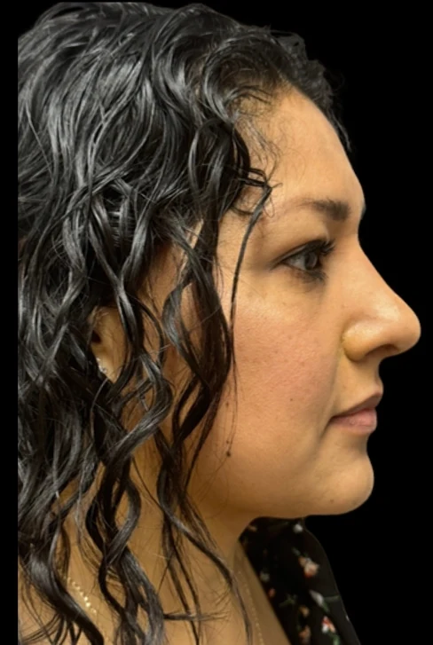 After: Rhinoplasty · by Angelo Cuzalina, MD, DDS