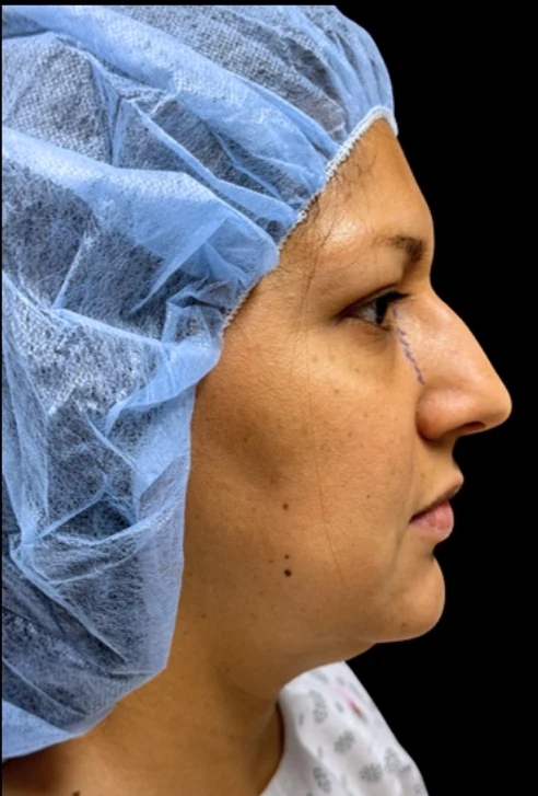 Before: Rhinoplasty · by Angelo Cuzalina, MD, DDS