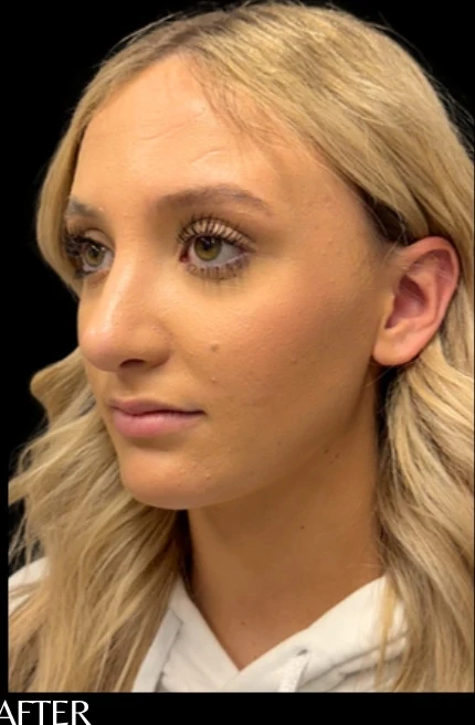 After: Rhinoplasty — oblique · by Angelo Cuzalina, MD, DDS