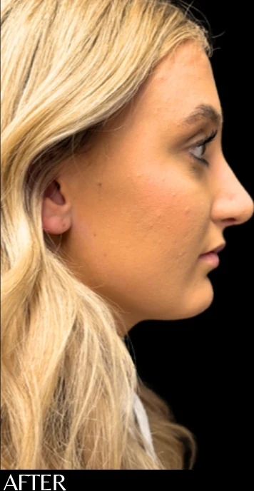 After: Rhinoplasty — profile · by Angelo Cuzalina, MD, DDS