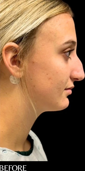 Before: Rhinoplasty — profile · by Angelo Cuzalina, MD, DDS