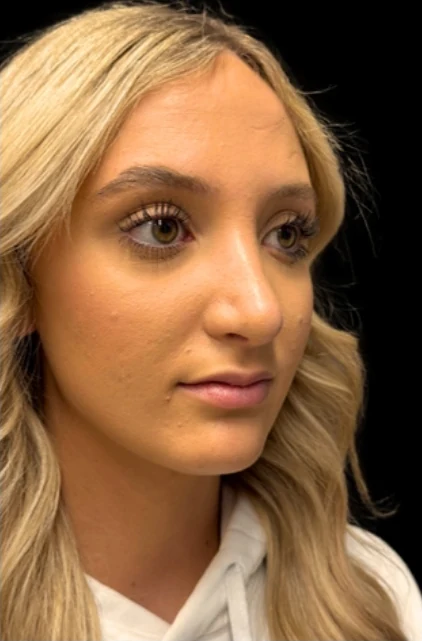 After: Rhinoplasty — three-quarter · by Angelo Cuzalina, MD, DDS