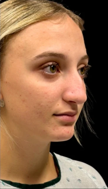 Before: Rhinoplasty — three-quarter · by Angelo Cuzalina, MD, DDS