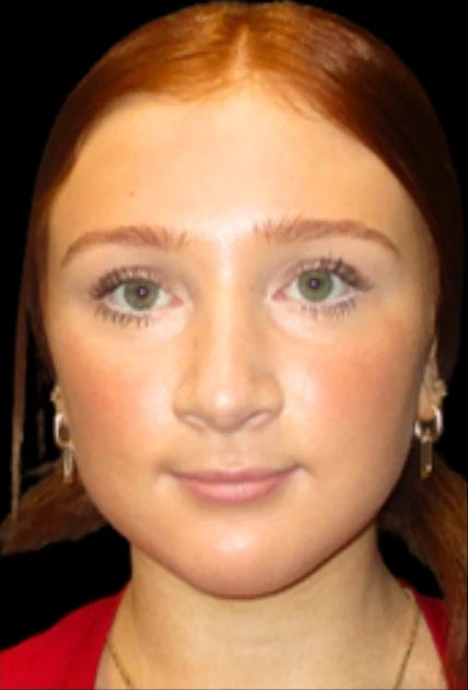 After: Rhinoplasty — front · by Angelo Cuzalina, MD, DDS