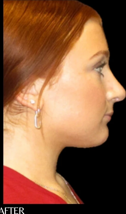 After: Rhinoplasty — profile · by Angelo Cuzalina, MD, DDS