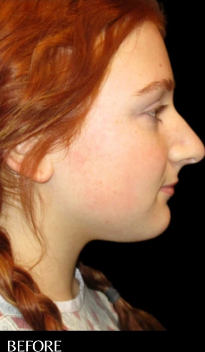 Before: Rhinoplasty — profile · by Angelo Cuzalina, MD, DDS