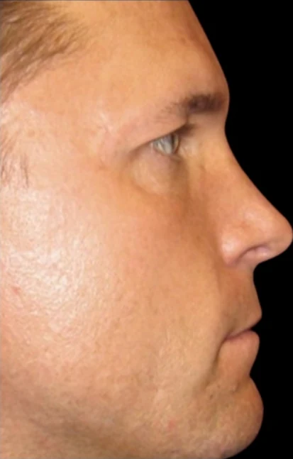 After: Rhinoplasty · by Angelo Cuzalina, MD, DDS