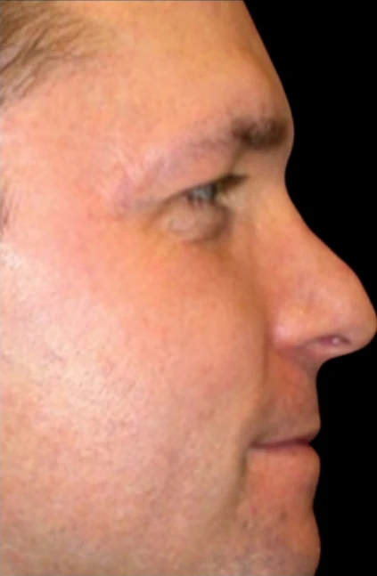 Before: Rhinoplasty · by Angelo Cuzalina, MD, DDS