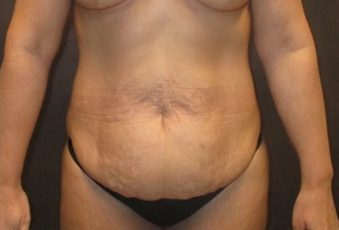 Before: Lipo360 & Tummy Tuck · by Angelo Cuzalina, MD, DDS