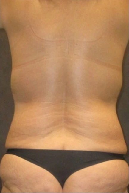 Before: Tummy Tuck & Lipo 360 to Waist and Hips — back · by Angelo Cuzalina, MD, DDS
