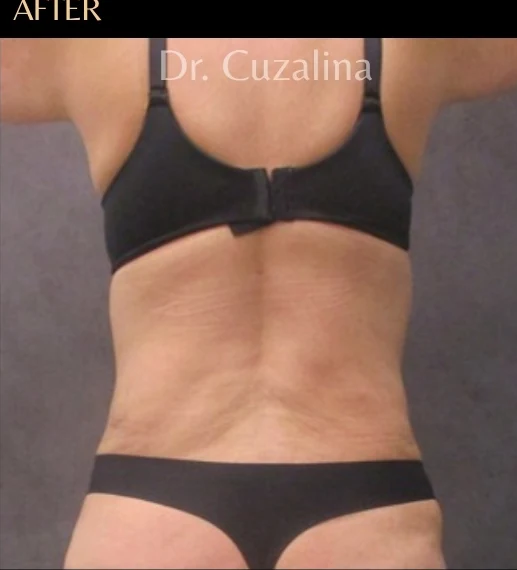After: Tummy Tuck & Lipo 360 — back · by Angelo Cuzalina, MD, DDS