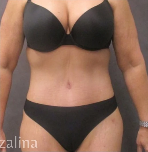 After: Tummy Tuck & Lipo 360 — front · by Angelo Cuzalina, MD, DDS