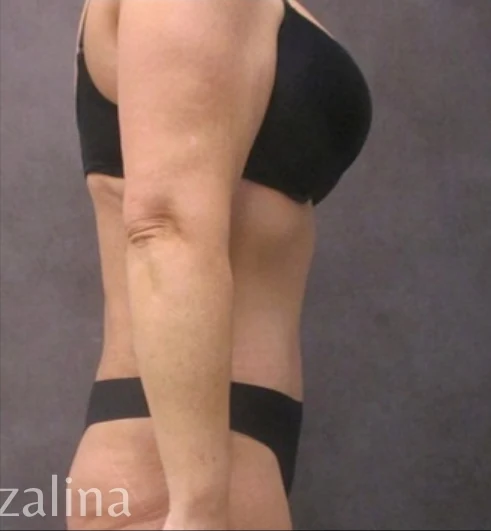 After: Tummy Tuck & Lipo 360 — profile · by Angelo Cuzalina, MD, DDS