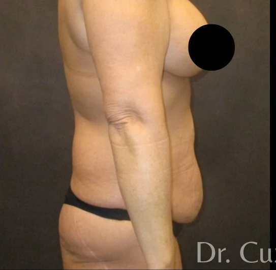 Before: Tummy Tuck & Lipo 360 — profile · by Angelo Cuzalina, MD, DDS