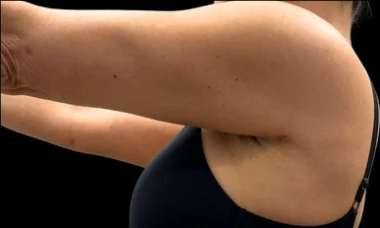 After: Full Tummy Tuck, Hidef Lipo & BBL — arms · by Pasquale Tolomeo, MD