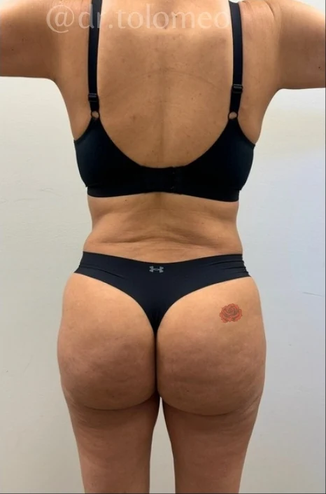 After: Full Tummy Tuck, Hidef Lipo & BBL — back · by Pasquale Tolomeo, MD