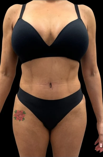 After: Full Tummy Tuck, Hidef Lipo & BBL — front · by Pasquale Tolomeo, MD