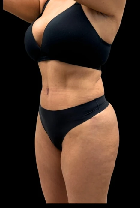 After: Full Tummy Tuck, Hidef Lipo & BBL — oblique · by Pasquale Tolomeo, MD