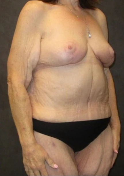After: Full Tummy Tuck | Lipo360 & Breast Reduction/Lift — oblique · by Angelo Cuzalina, MD, DDS