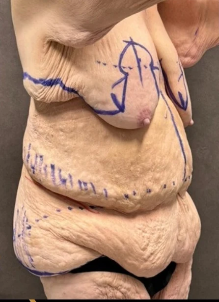 Before: Full Tummy Tuck | Lipo360 & Breast Reduction/Lift — oblique · by Angelo Cuzalina, MD, DDS
