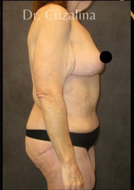 After: Full Tummy Tuck | Lipo360 & Breast Reduction/Lift — profile · by Angelo Cuzalina, MD, DDS